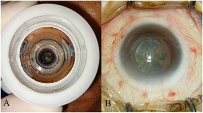 Postoperative dry eye following femtosecond laser-assisted cataract surgery: insights and preventive strategies